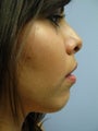Chin Augmentation