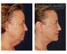 Facial Rejuvenation - Chin Implant