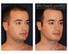 Chin Implant