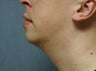chin augmentation