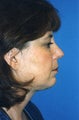 Chin Implant