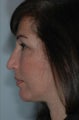 Fat Injections, Chin Implant, Submental Liposuction, Facelift, Lower Lid 88% Phenol Peel