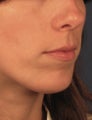 Chin Implant