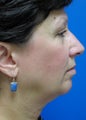 Chin Implant 