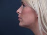 Chin Implant