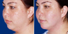 Chin Implant