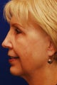 Chin Implant