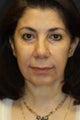upper/lower blepharoplasty with facelift, chin augmentation, radiesse, and buccal fat removal