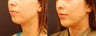 Chin Implant Surgery