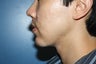 Chin augmentation