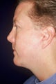 Chin Implant