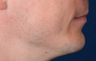 Chin Implant