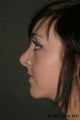 Chin Augmentation & Rhinoplasty