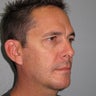 Chin Implant and Neck Liposuction