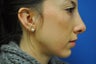 Chin Augmentation with Rhinoplasty
