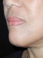 Chin Augmentation
