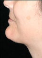 Chin Liposuction and Augmentation