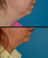 Chin implant - chin augmentation and neck liposuction