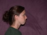 chin augmentation with chin implant