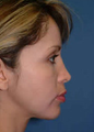 Chin Implant and Liposuction