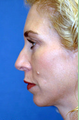 Chin Implant and Rhinoplasty