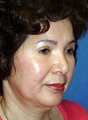 Facelift and Chin Implant