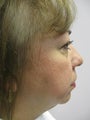 Chin Implant