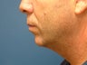 Chin Implant & Liposuction