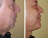 Chin Augmentation