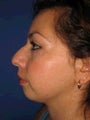 Chin Implants