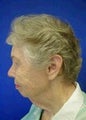 Chin Implants