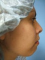 Chin Augmentation