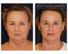 Facial Rejuvenation - Chin Implant