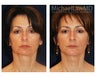Chin Implant