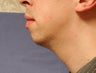 chin augmentation