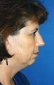 Chin Implant