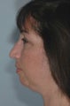 Fat Injections, Chin Implant, Submental Liposuction, Facelift, Lower Lid 88% Phenol Peel