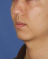 Chin Implant