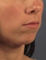 Chin Implant