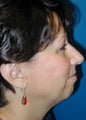 Chin Implant 