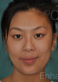 Sliding Genioplasty + Jaw