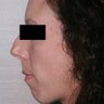 Chin Implant