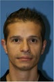 Chin Implant, Jaw Implant