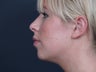 Chin Implant
