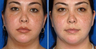 Chin Implant