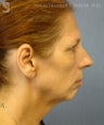 Chin Implant