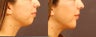 Chin Implant Surgery