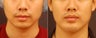Chin Implant