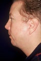 Chin Implant