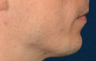 Chin Implant